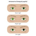 Realistic human eyes with anisocoria vector illustration design