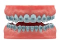 healthy teeth and classic metal braces, front view
