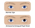 Realistic human normal eyes and with anisocoria