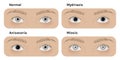 Realistic human normal eyes and with mydriasis, anisocoria, miosis Royalty Free Stock Photo