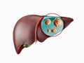 Realistic illustration of cancer of human liver