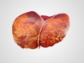 Realistic illustration of cirrhosis of human liver Royalty Free Stock Photo