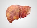 Realistic illustration of cirrhosis of human liver