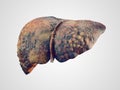 Realistic illustration of cirrhosis of human liver Royalty Free Stock Photo