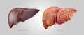 Realistic illustration of healthy and sick human livers