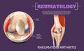 Realistic Illustration Knee Rheumatoid Arthritis Royalty Free Stock Photo