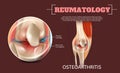 Realistic Illustration Osteoarthritis Knee Joint