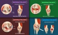 Realistic Illustration Reumatology Medicine in 3d