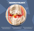 Realistic Illustration Reumatology Medicine in 3d