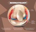 Realistic Illustration Reumatology Medicine in 3d