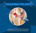 Realistic Illustration Traumatology Medicine in 3d Royalty Free Stock Photo