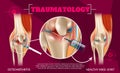 Realistic Illustration Traumatology Medicine in 3d