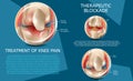 Realistic Illustration Treatment of Knee Pain Royalty Free Stock Photo