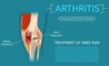 Realistic Illustration Treatment of Knee Pain