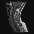 Realistic image sagittal of cervical spine with CT scan, MRI Magnetic resonance imaging layer of spine neck. Royalty Free Stock Photo