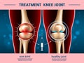 Realistic knee joints. Osteoarthritis treatment, anti inflammatory injection, 3d anatomical part, leg bones and