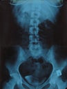 Realistic Lumbar spine x ray, pelvic bones MRI scan picture. Vector illustration Royalty Free Stock Photo
