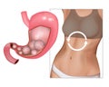 Realistic medical illustration abdominal bloated. Feeling bloated concept