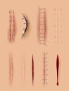 Realistic scars. Medical surgical sutures wounds close up pictures on human skin decent vector illustrations set