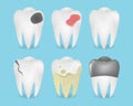 Realistic white and caries broken teeth set illustration