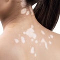 Rear view on female back with vitiligo. Royalty Free Stock Photo