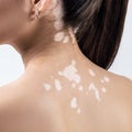 Rear view on female back with vitiligo. Royalty Free Stock Photo