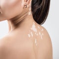 Rear view on female back with vitiligo. Royalty Free Stock Photo