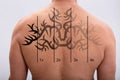 Laser Tattoo Removal On Man`s Back Royalty Free Stock Photo