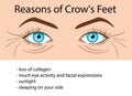 Reasons od Crows feet wrinkles, vector illustration