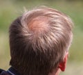 A receding hairline on a man's head