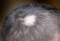 A receding hairline on a man`s head