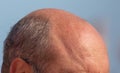 A receding hairline on a man's head.