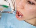 The reception was at the female dentist. Doctor examines the oral cavity on tooth decay. Caries protection. doctor puts Royalty Free Stock Photo