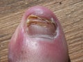 Recouperating toenail