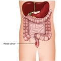 Rectal cancer medical 3d  illustration on white background, colorectal cancer Royalty Free Stock Photo