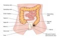 Rectal cancer and stoma