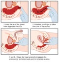 Rectal examination Royalty Free Stock Photo