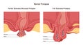 Rectum prolapse. Two types of proctological disease. Human anus