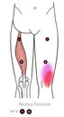 Rectus femoris myofascial trigger points and knee pain