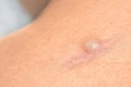 Recurrence Sebaceous Cyst (Epidermoid Cysts) at the incision of surgery on woman's shoulder blade. Royalty Free Stock Photo