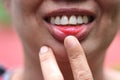 Red aphthae aphthous stomatitis on asian woman lip