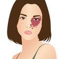 Red birthmark nevus vascular on woman\'s face, illustration on white background