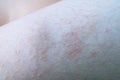 Red blister are caused by hairy caterpillar Royalty Free Stock Photo