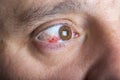 Red bloddshot eyes Royalty Free Stock Photo