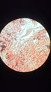 Red blood cell (erythrocytes) in urinalysis