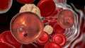 Red blood cell infected with malaria parasite Plasmodium vivax, ring stage