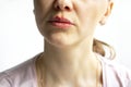 Red bubbles of herpes on lips of a woman in light pink t-shirt, lower part face is seen. Medicine, treatment Royalty Free Stock Photo