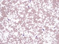 Red cell agglutination in a patient with cold agglutinin disease.