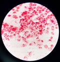 Red cell D-shape Gram-negative diplococci in vaginal smear