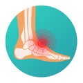 Red circle pain localization in human foot, foot injury, skeleton, joints and bones